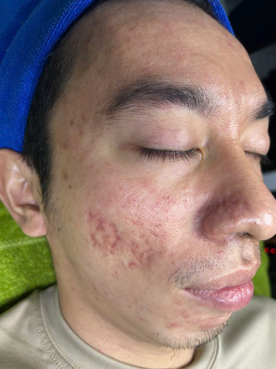 Trị mụn cho Anh Đức