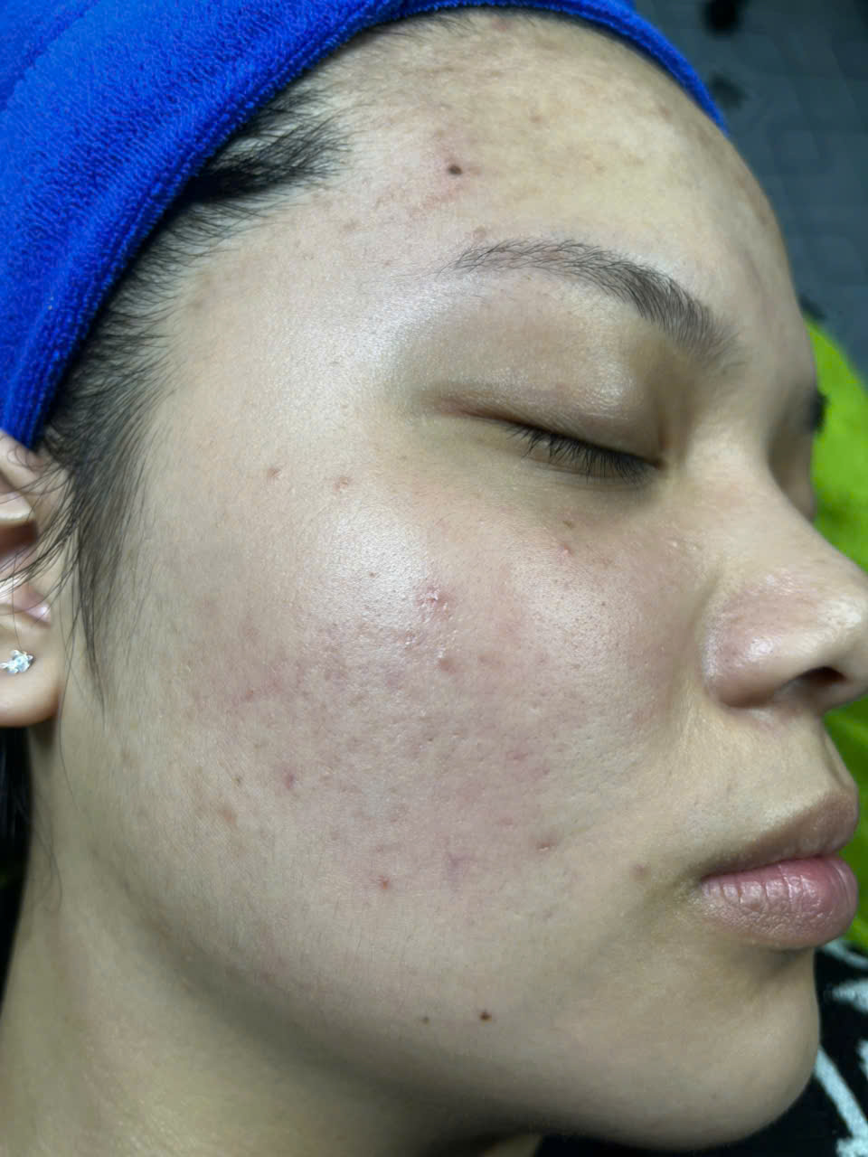 Trị Mụn Cóc cho chị Lan