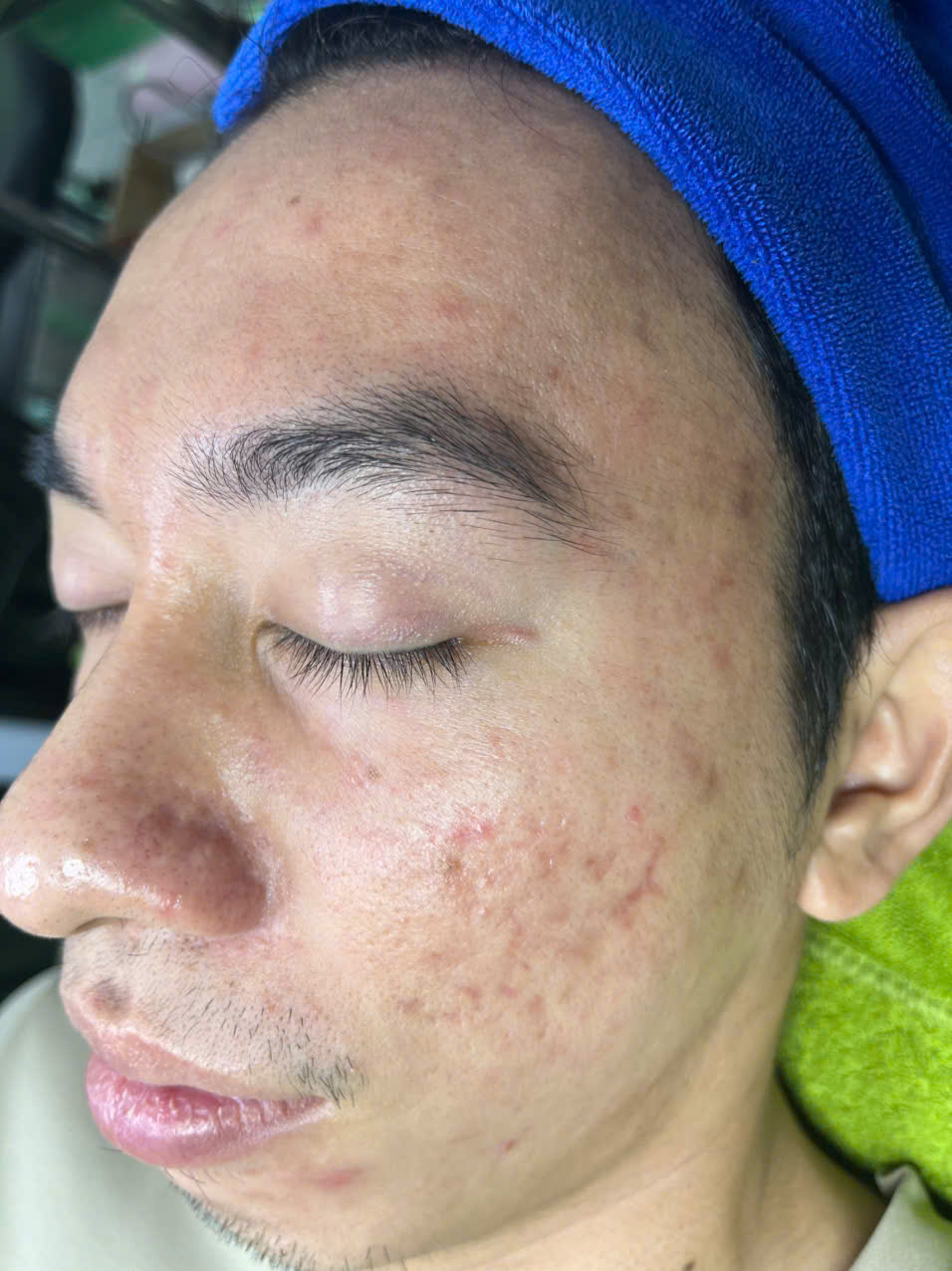 Điều trị mụn