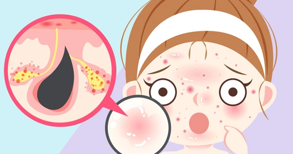 Lý Do Mọc Mụn Ở Tuổi Dậy Thì – Nguyên Nhân & Cách Khắc Phục