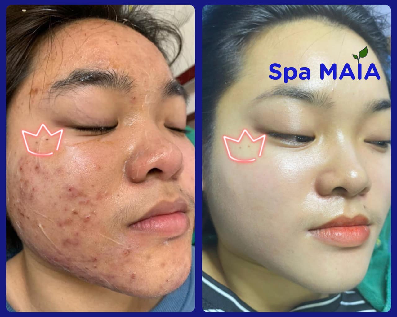 Chăm Sóc Da Mụn 
