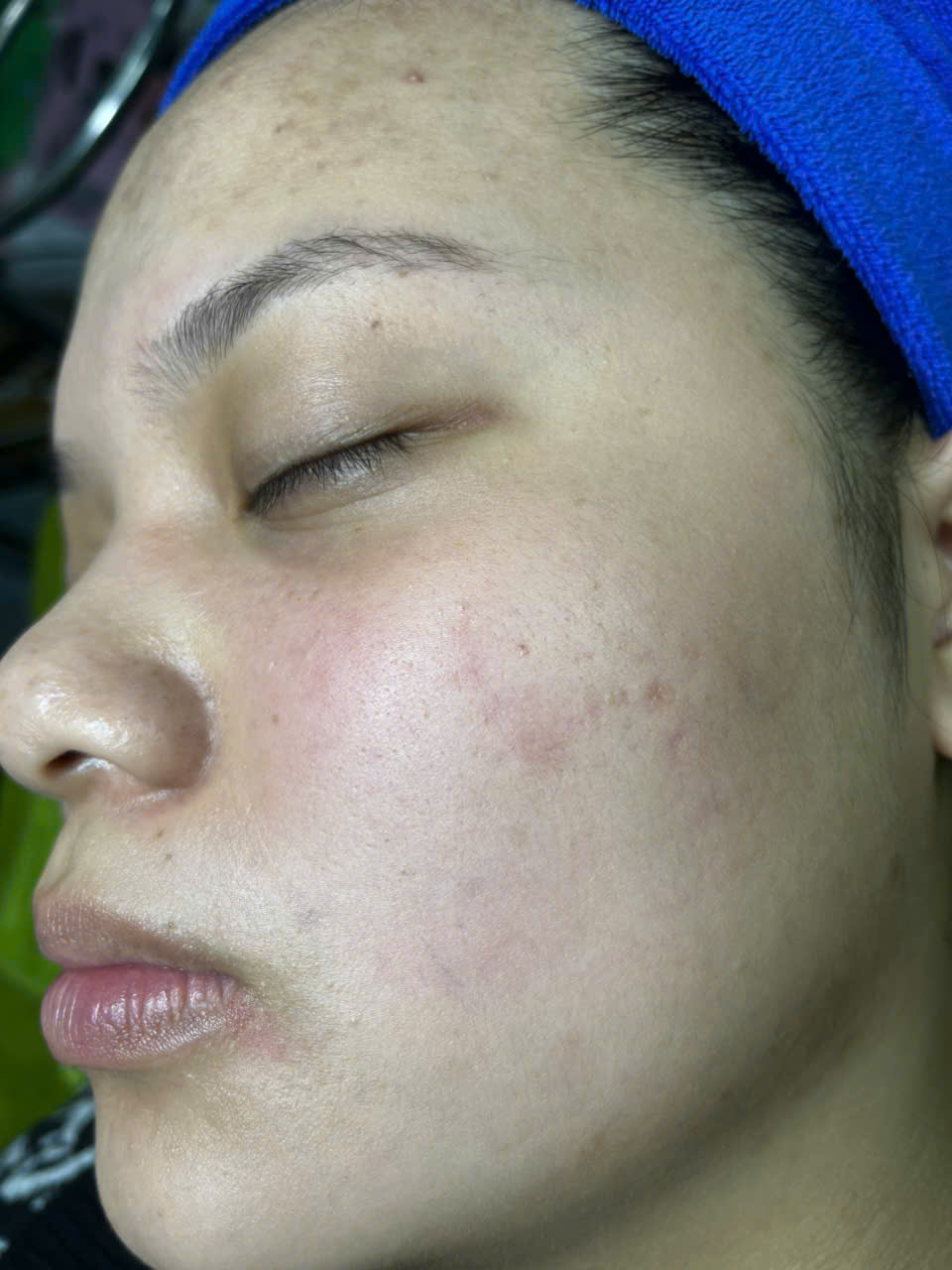 Trị Mụn Chuyên Sâu